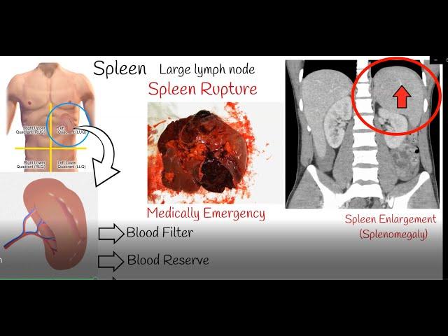 Spleen pain, Spleen enlargement and Spleen rupture. Causes and treatment