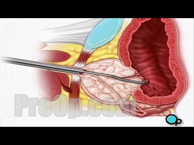 TURP Transurethral Resection Prostate Surgery, patient education series