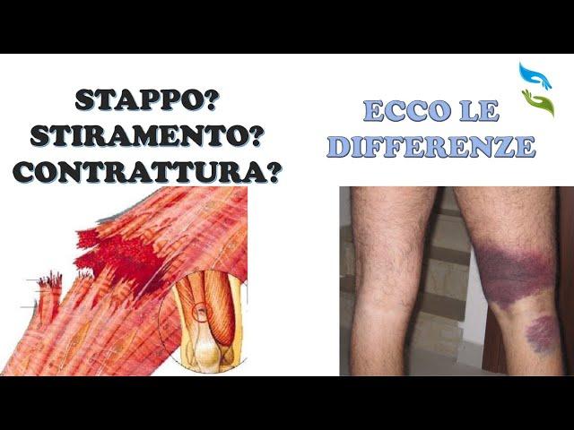 Contrattura, stiramento o strappo muscolare? Ecco come distinguere.