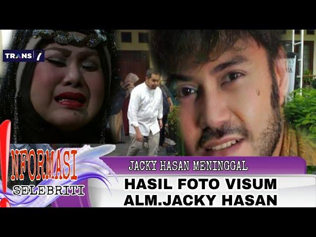 TUMOR YANG MERENGGUT JACKY HASAN(GOSIP ARTIS HARI INI).BERITA ARTIS HARI INI