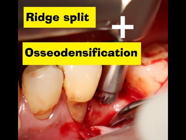 Ridge split + osseodensification