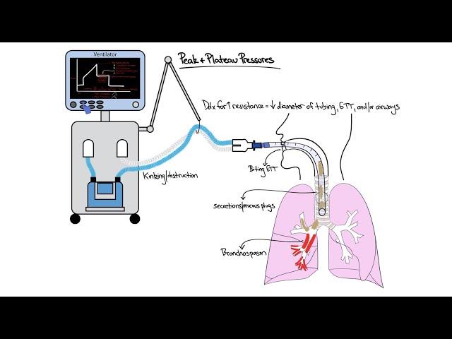 Chalk Talk: Peak & Plateau Pressures