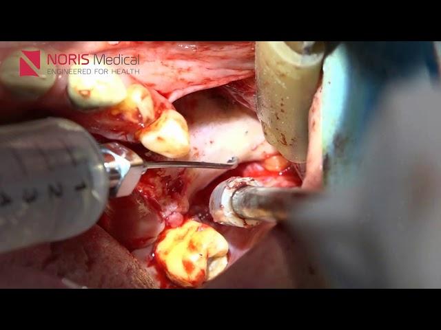 Zygomatic Extra Maxillary Guided Surgery   Noris Medical