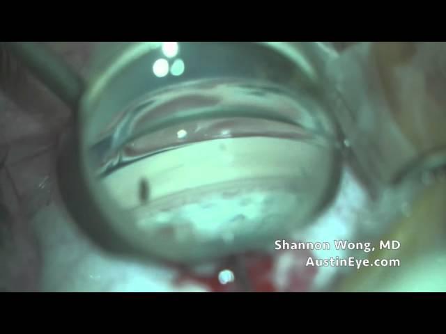 Perfect iStent Insertion.  Shannon Wong, MD 11-1-15