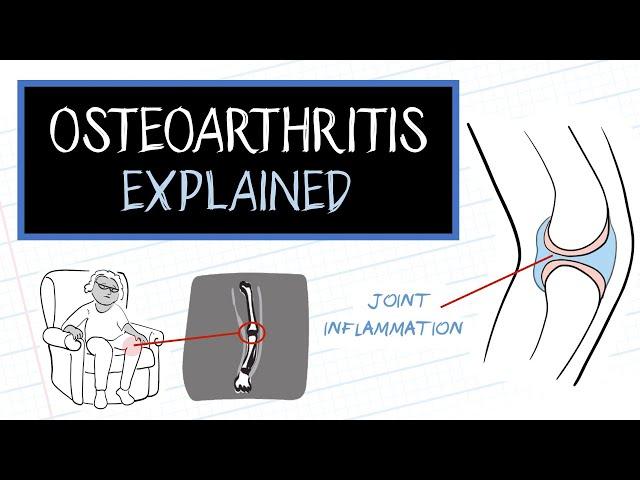 What is Osteoarthritis? (HealthSketch)