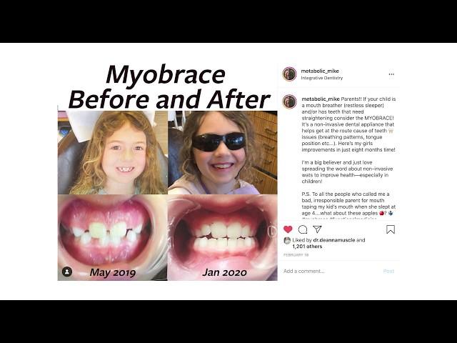 Tool to Stop Mouth Breathing Actually Changed my Kids' Face: MYOBRACE review