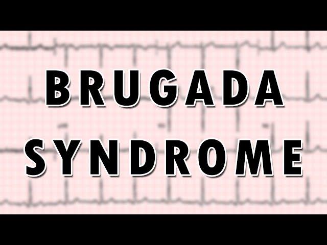 Brugada syndrome