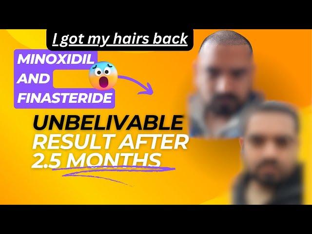 I got my hairs back - Minoxidil and finasteride results after 2.5 Months #minoxidil #finasteride