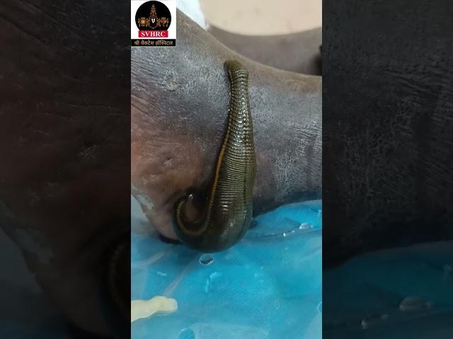 Leech Therapy for remove bad blood #shorts #youtubeshorts #shortsfeed #trending #viral #love #life