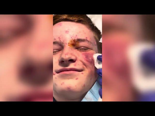 Popping huge blackheads and Giant Pimples - Best Pimple Popping Videos #184