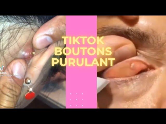 TIKTOK BOUTON PIMPLE POPPING 5