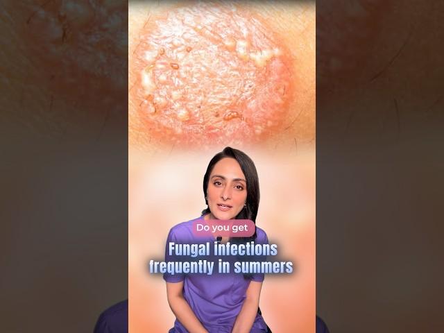 Fungal infection | kaise prevent kare | dermatologist