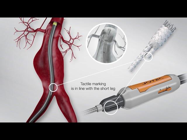 JOTEC E-tegra Stent Graft System Animation