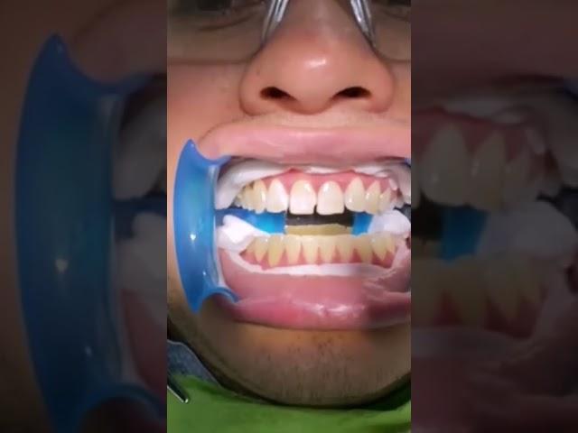 ¡ASÍ SE HACE UN BLANQUEAMIENTO DENTAL DE CONSULTORIO!