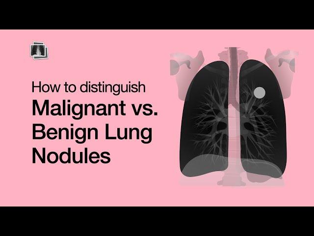 Distinguish Malignant vs. Benign Lung Nodules