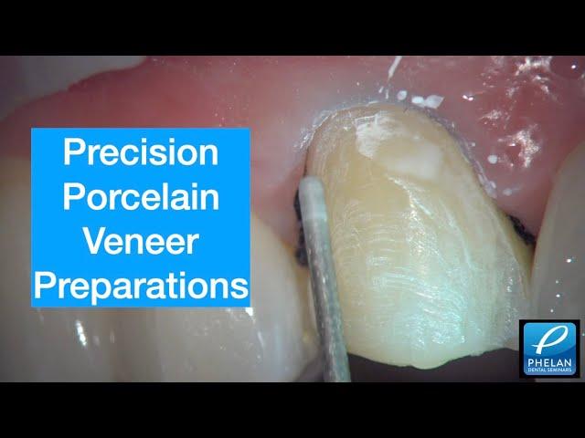 Precision Porcelain Veneer Preparation with a Zeiss ProErgo microscope.