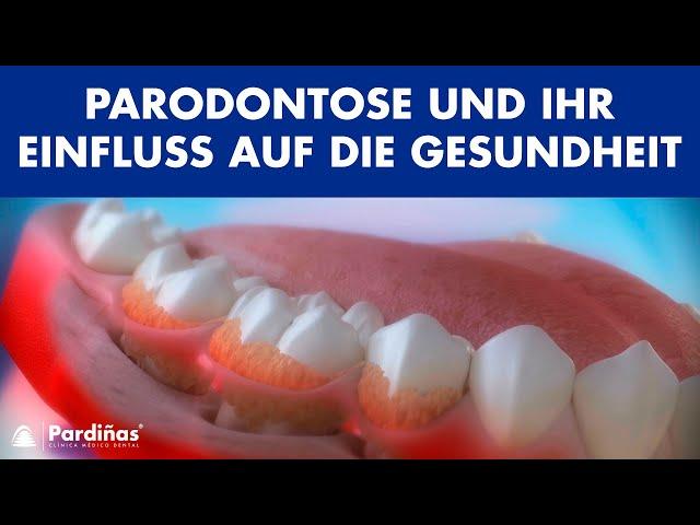 Parodontose und ihr Einfluss auf die Gesundheit ©