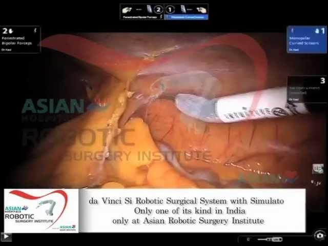 Asian Heart Hospital - Robotic Partial Nephrectomy