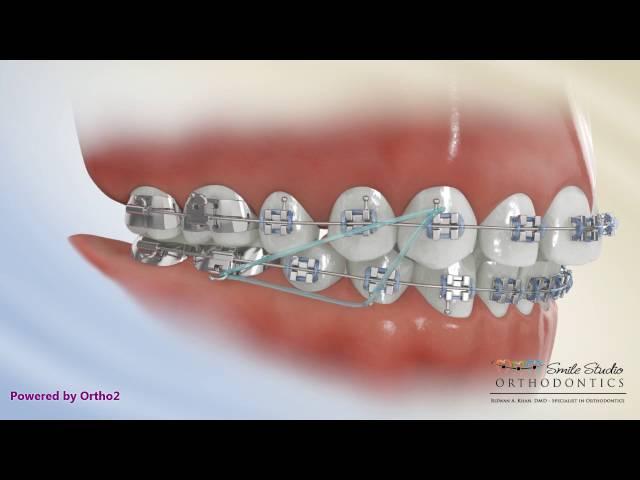 Elastics - Class II Triangle 3 to 4-6 - Orthodontic Treatment