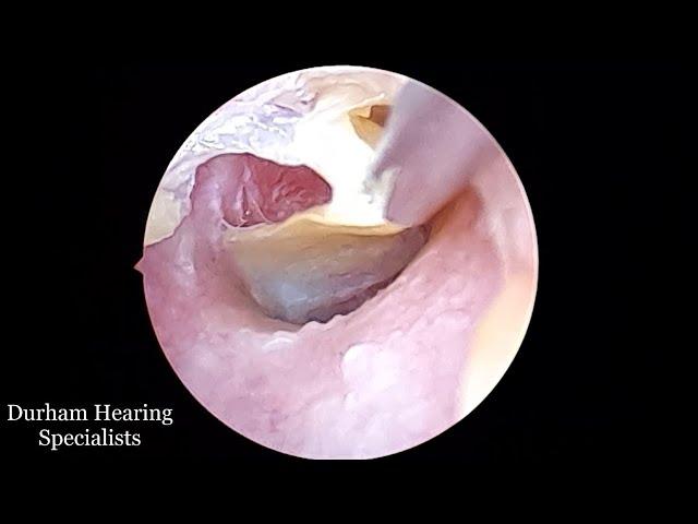 Thick Dead Skin Sheet Peeled Off Eardrum (Suction Extraction)