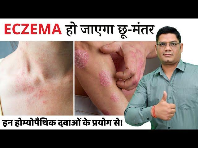 Eczema Homeopathy Best Medicine Treatment | Causes, Symptoms and More | Dr. Sunil Patidar #eczema