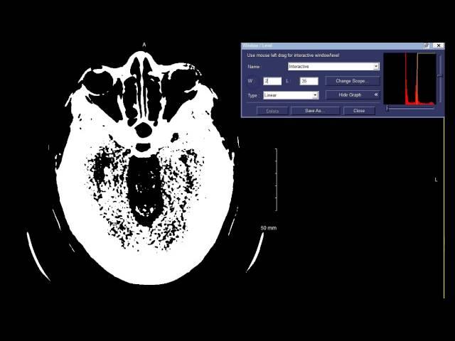 Window Width & Window Level (W/L) Concepts - CT Head Example