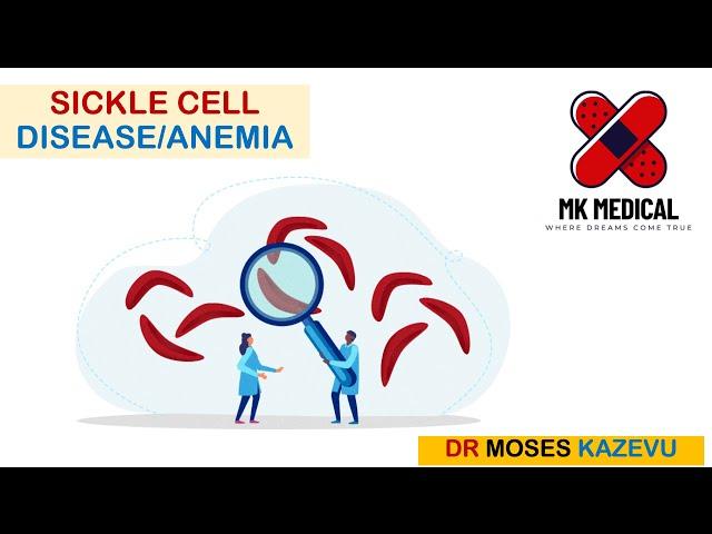 Sickle cell Anemia || SCA || SCD