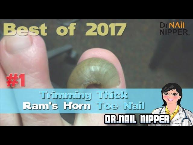 Rams Horn Toenail [#1 Best of 2017] - Trimming Thick Ram's Horn. What is ram's horn toenail? (2017)