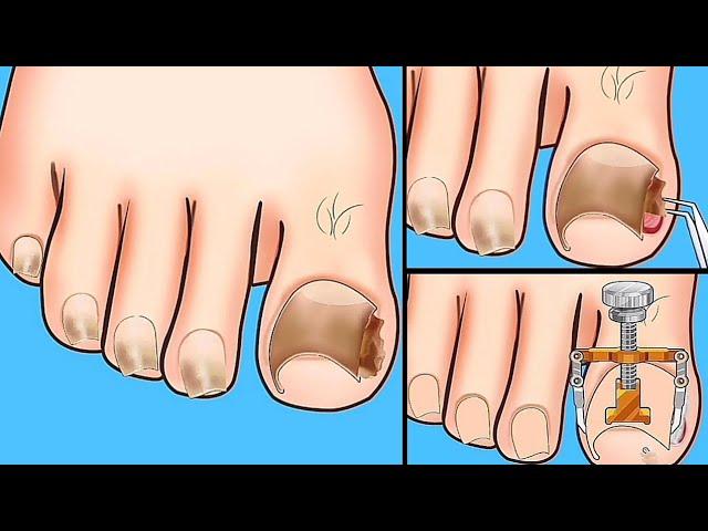 ASMR | Caring for injured and dirty toenails | Asmr Salon Foot Care Makeover