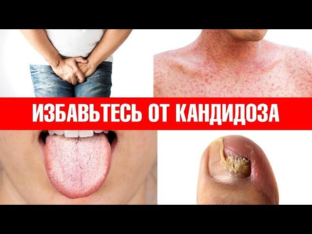 Примените эти 6 средств, и кандидоз никогда не вернется