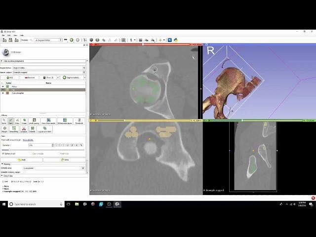 DICOM to STL Conversion Tutorial with Segment Editor