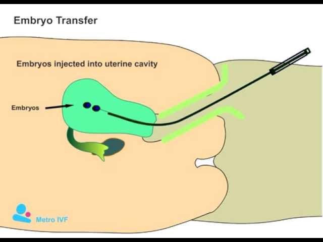 Embryo Transfer procedure