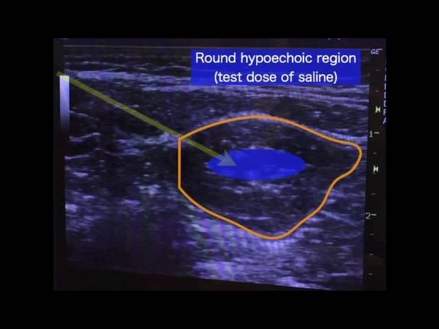 Quadratus lumborum block intramuscular approach