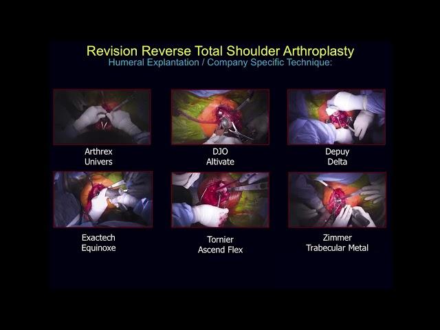 Sugical Techniques - Failed Reverse Total Shoulder Arthroplasty.