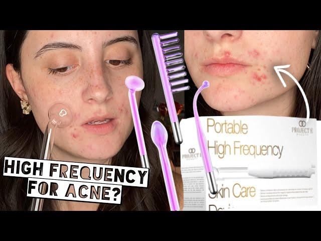 TESTING HIGH FREQUENCY ON ACNE FOR 2 WEEKS | Project E Beauty Argon High Frequency Skincare Device