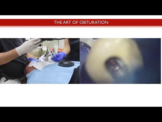 Eighteeth Fast-Pack Clinical Case by Dr.Massimo Giovarruscio