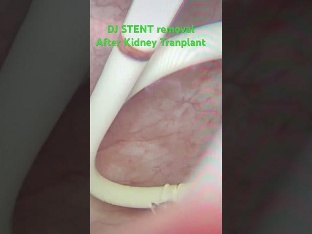 Inside operation- DJ stent removal after kidney transplant