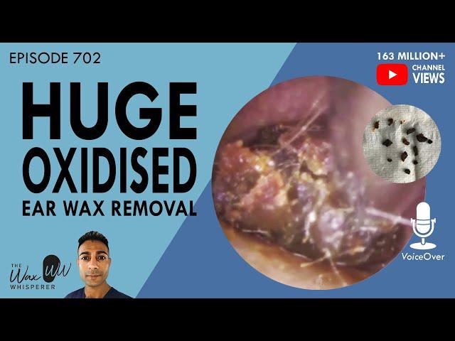 702 - Huge Oxidised Ear Wax Removal