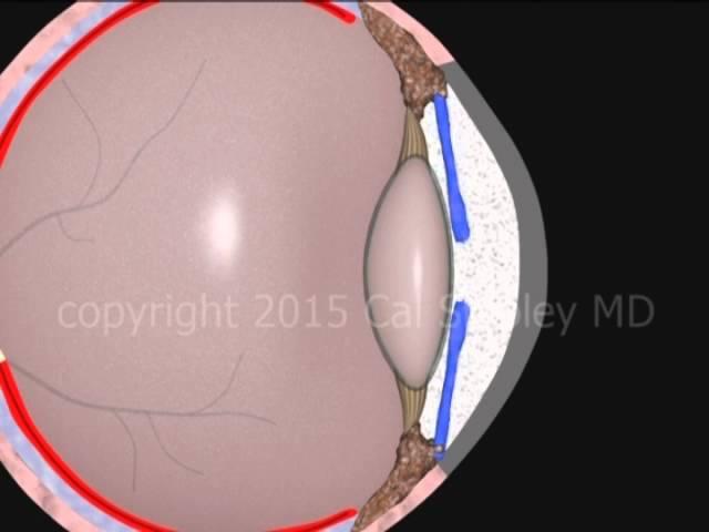 Cataract Surgery (phacoemulsification) by Cal Shipley, M.D.