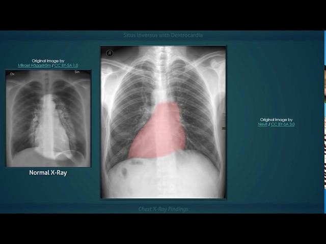 Situs Inversus with Dextrocardia: Explanation of Chest X-ray Findings