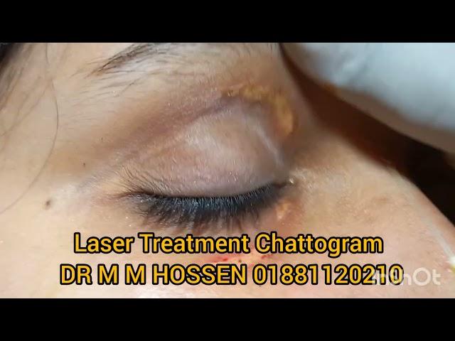 Xanthelasma treatment now in Chittagong Chattogram  01881120210