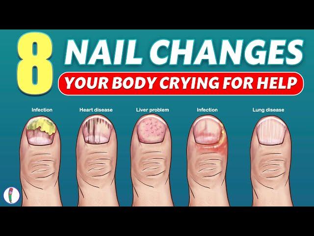 Nail signs of Disease | Nail pitting | Finger clubbing | Signs of anemia | Terry's nails