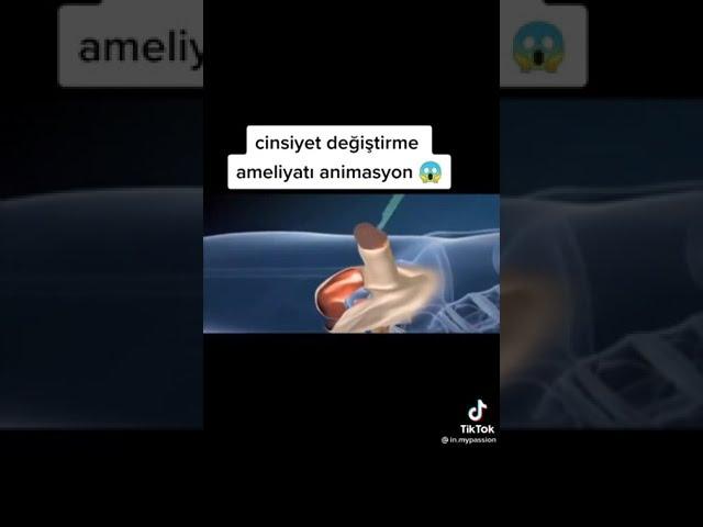 CİNSİYET DEĞİŞİM AMELİYATI