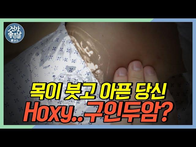 목이 붓고 아파요 혹시.. 구인두암? #구인두암 [#건강좋은날플러스 ep.43]｜MBC경남 221026 방송