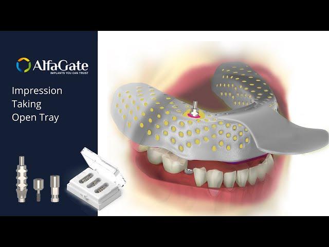 Implant impression taking- open tray | Alfa Gate