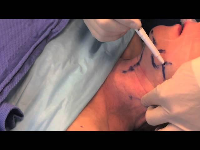 Neck Lift - Surgical Procedure By Dr. Craig Jonov, Seattle WA