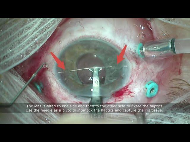 Needle guided technique for iris claw IOL implantation - Dr Sami A. Saad