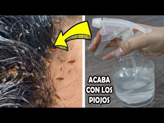 Acaba en 20 Minutos con todos los PIOJOS y LIENDRES con este remedio casero