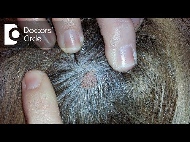 What does small skin colored lump on the scalp indicate? - Dr. Urmila Nischal