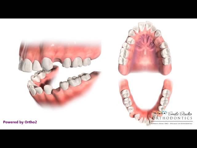 4 First Premolar Extraction for Retraction - Orthodontic Treatment